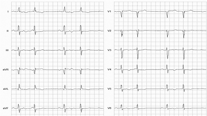 SVEB Patterns (Bigeminy) 12 Lead EKG